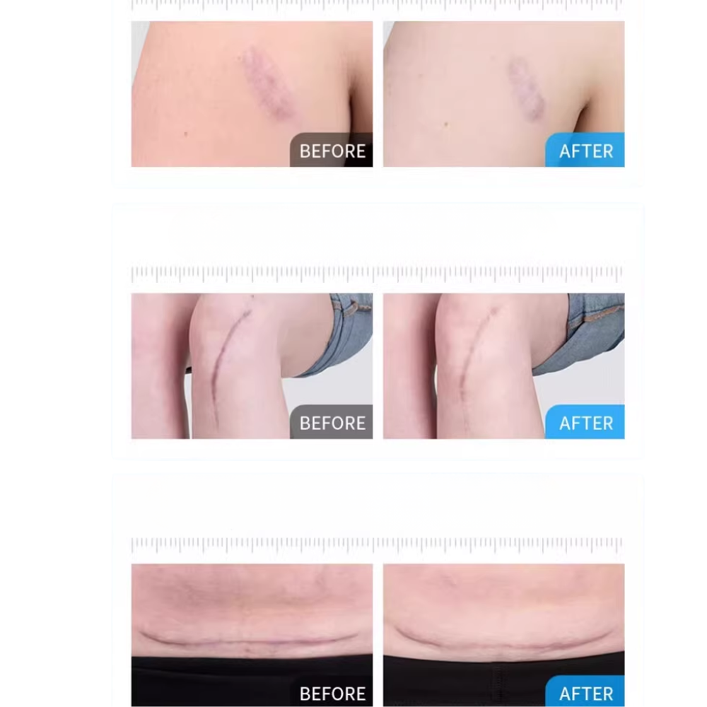 KELO-COTE Scar Gel 6g / 15g /30g