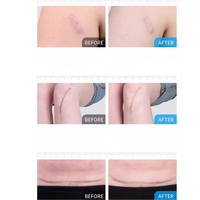 KELO-COTE Scar Gel 6g / 15g /30g