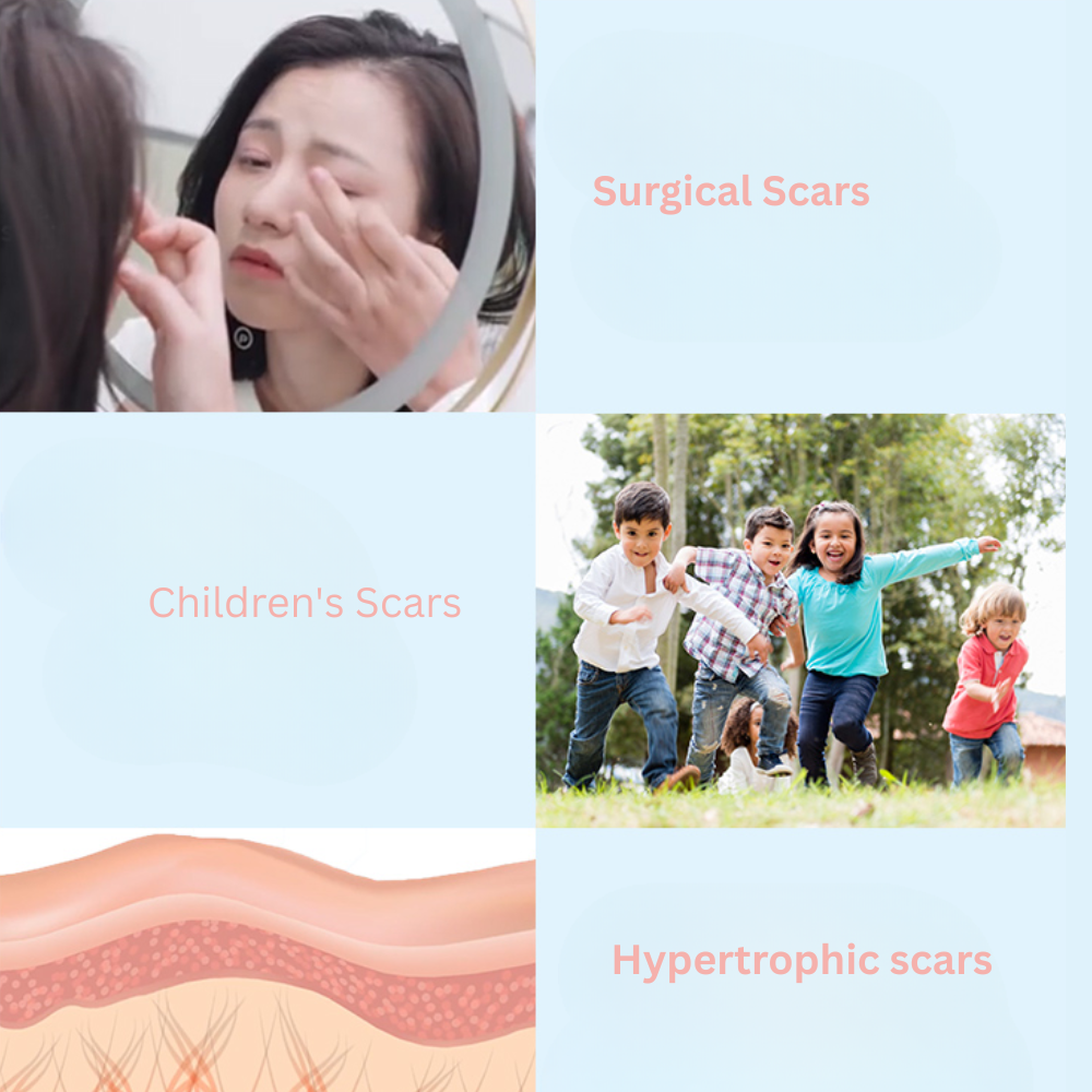 KELO-COTE Scar Gel 6g / 15g /30g