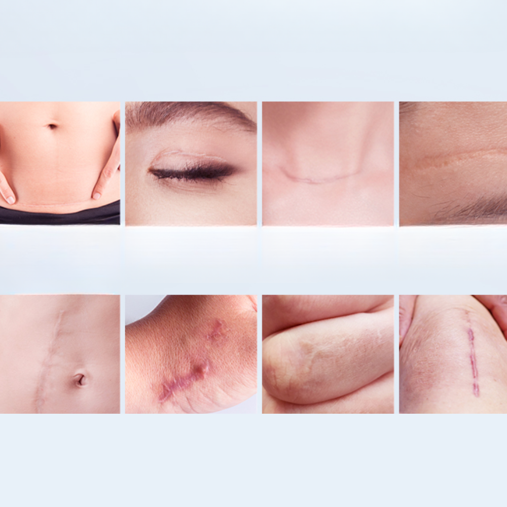 Mepiform Ultra Scar Gel 15 g